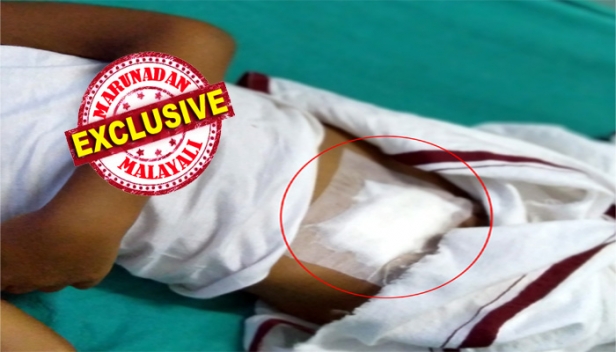 ആറ് വയസ്സുകാരൻ ധനുഷിന് വേണ്ടിയിരുന്നത് മൂക്കിൽ ദശ വളർന്നതിന്റെ ശസ്ത്രക്രിയ; ധാനിഷിന് ചെയ്യേണ്ടിയിരുന്നത് ഹെർണിയ ശസ്ത്രക്രിയ; അനസ്തേഷ്യ കൊടുത്ത് ഓപ്പറേഷൻ തിയറ്ററിൽ പ്രവേശിപ്പിച്ച ധനൂഷിന് ചെയ്തത് ധാനിഷിന് ചെയ്യേണ്ടിയിരുന്ന ഹെർണിയ ഓപ്പറേഷൻ; മൂക്കിന് പകരം വയറിൽ തുന്നിക്കെട്ട് കണ്ട് ഞെട്ടി രക്ഷിതാവ്; പേരിലെ സാമ്യത കൊണ്ട് മാറിപ്പോയെന്ന് വിചിത്ര വാദം ഉയർത്തി ഡോക്ടർ; ആള് മാറി ശസ്ത്രക്രിയ നടത്തിയ മഞ്ചേരി മെഡിക്കൽ കോളേജിനെതിരെ പ്രതിഷേധം വ്യാപകം
