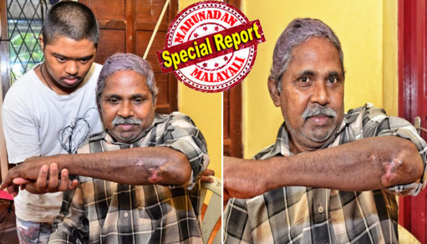 ചികിത്സയ്ക്കായി അഡ്മിറ്റ് ചെയ്ത ശേഷം അഴിച്ചുവിട്ടതുകൊടിയ മർദ്ദനം; നാലുപേർ ചേർന്ന് ഇരുമ്പുവടിയും വിറകുമായി തല്ലിച്ചതച്ചപ്പോൾ ഇടതുകൈ ഒടിഞ്ഞുതൂങ്ങി; കുളിമുറിയിൽ വീണതാണെന്ന് നിർബന്ധിച്ച് എഴുതി വാങ്ങിച്ചു; ചലനശേഷി നഷ്ടമായ കൈ പഴയപോലാകില്ലെന്ന് വിധിയെഴുതി ഡോക്ടർമാർ; പെരുമ്പാവൂർ അഭയകേന്ദ്രത്തിലെ ക്രൂരതയിൽ പരാതിപ്പെട്ടെങ്കിലും തിരിഞ്ഞുനോക്കുന്നില്ലെന്ന് ഓട്ടോ ഡ്രൈവർ ഷാജി