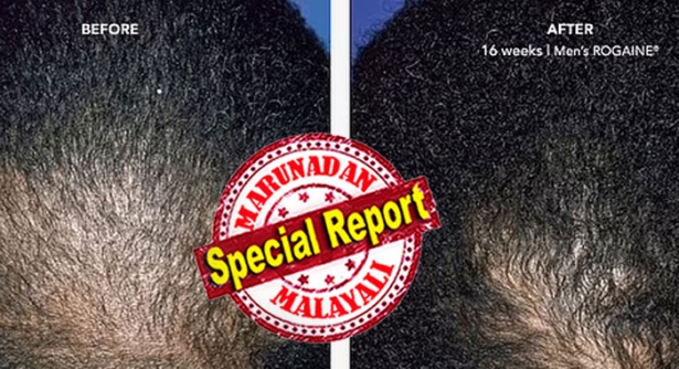 മുടികൊഴിച്ചിൽ തടയുന്ന മിനോക്സിഡിൽ നഷ്ടപ്പെട്ട മുടി വീണ്ടെടുക്കുമെന്ന് പഠന റിപ്പോർട്ട്; കഷണ്ടിക്ക് മരുന്നു കണ്ടു പിടിച്ചതിന്റെ സൂചനയുമായി ശാസ്ത്രലോകം; മുടി കിളിർപ്പിക്കാൻ പക്ഷെ ലോഷനു പകരം ഗുളിക വേണം